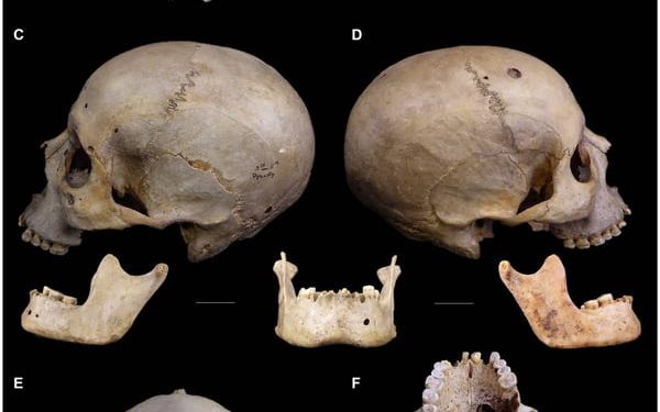 Crânios de 4 mil anos mostram sinais de tentativas de tratar câncer