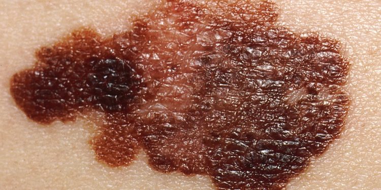 Vírus da herpes modificado reduz melanoma avançado em ensaio clínico