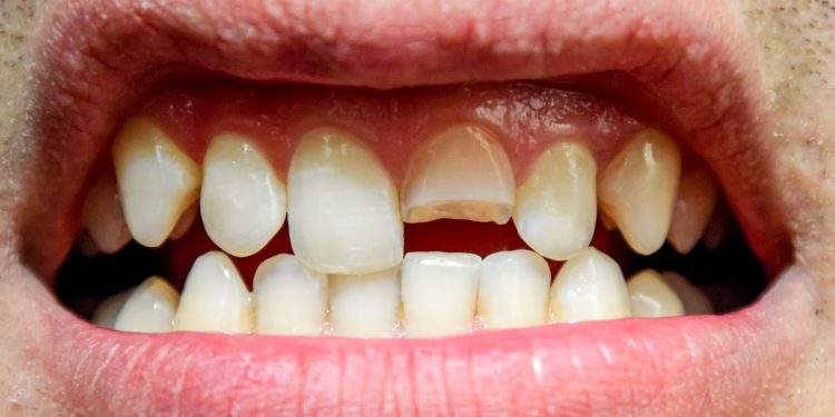 Quebrou o dente? Especialista explica como agir nessa situação