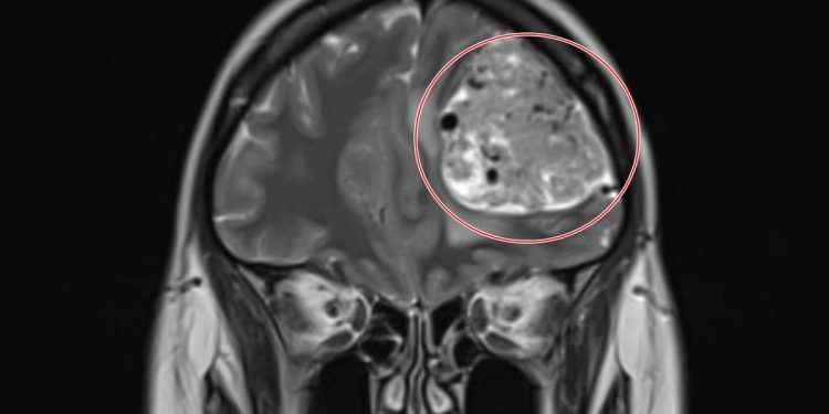 Com dor de cabeça frequente, mulher descobre tumor cerebral de 15 anos