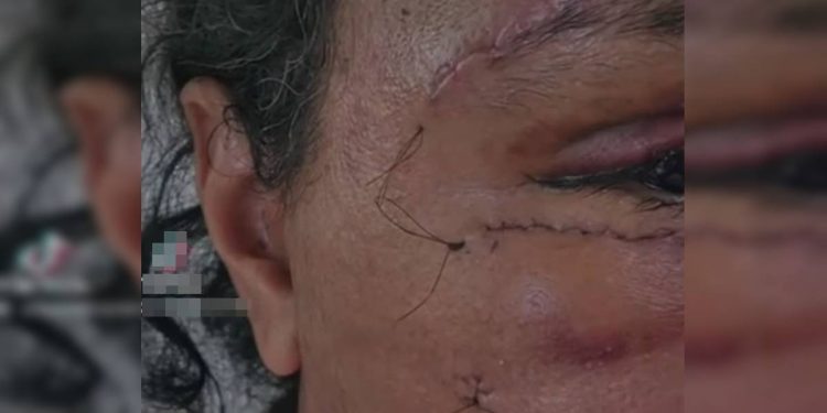 Mulher que levou 61 socos mostra rosto em recuperação: “Mão de Deus”