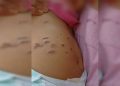 Menina de 10 meses foi queimada por cigarros na barriga e nas pernas