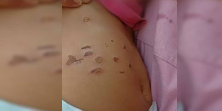 Menina de 10 meses foi queimada por cigarros na barriga e nas pernas