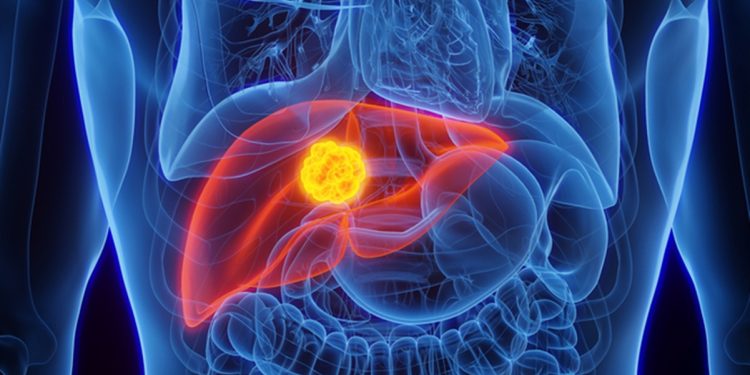 Câncer de fígado: conheça as principais causas e como se prevenir