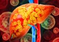 Gordura no fígado: saiba quais são os sintomas da esteatose hepática