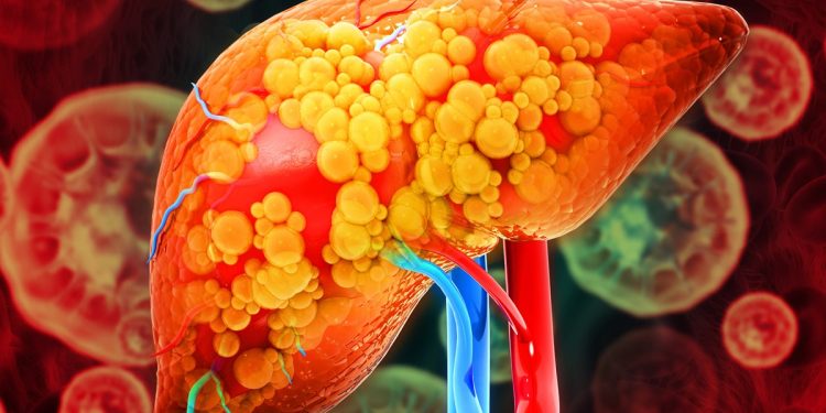 Gordura no fígado: saiba quais são os sintomas da esteatose hepática