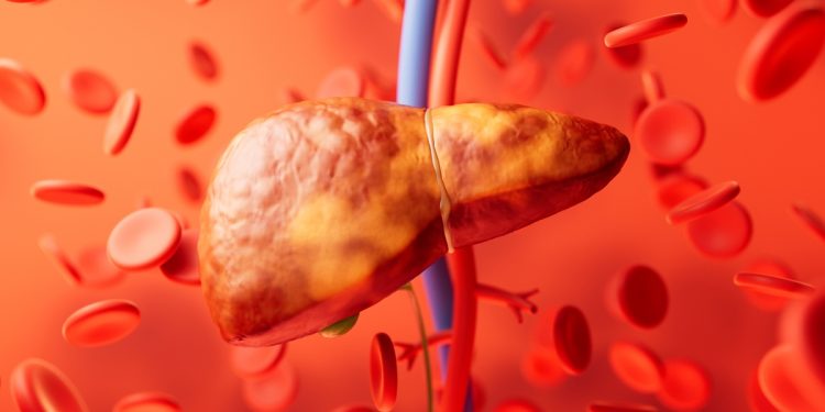 Gordura no fígado: saiba por que é vital proteger o órgão da condição