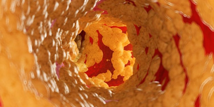 Cardiologista explica o que acontece no corpo quando artérias entopem