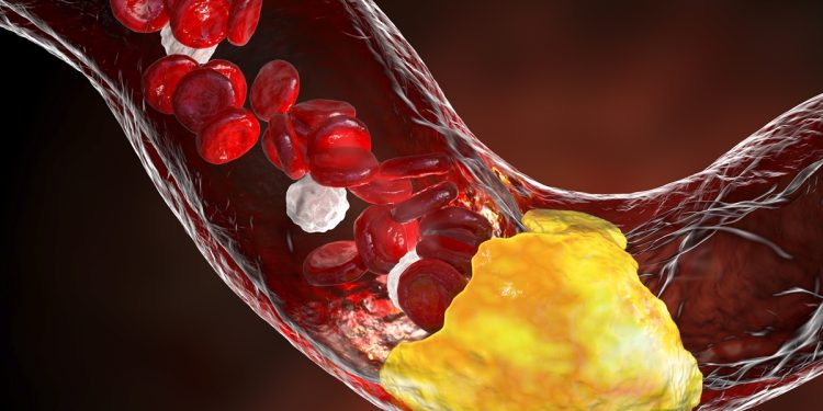 Cardiologista cita principais sintomas de que artérias estão entupidas