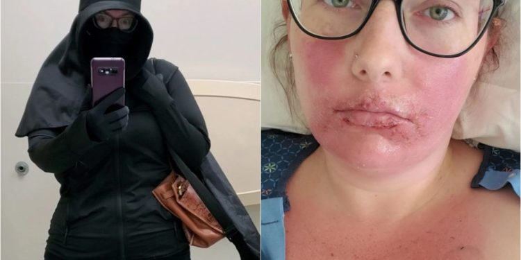 “Tenho que viver como uma vampira”, diz mulher com alergia ao sol