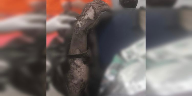 Veja como trabalhador queimado após explosão chegou a hospital no DF