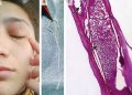 Verme vivo de 11 cm é retirado da pálpebra de mulher na Romênia