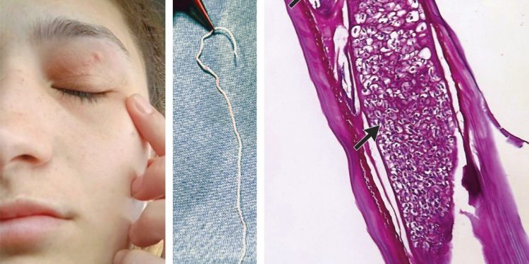 Verme vivo de 11 cm é retirado da pálpebra de mulher na Romênia