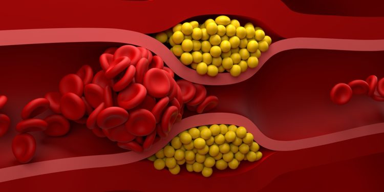 Aterosclerose: artérias “entupidas” podem causar doença inflamatória