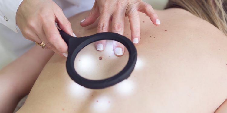 Hran oferece exame gratuito de câncer de pele neste sábado (13/12)