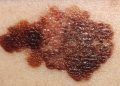 Câncer de pele: dermatologista diz como identificar sinais suspeitos