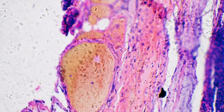 Câncer de pele: oncologista aponta 5 pontos essenciais para prevenção