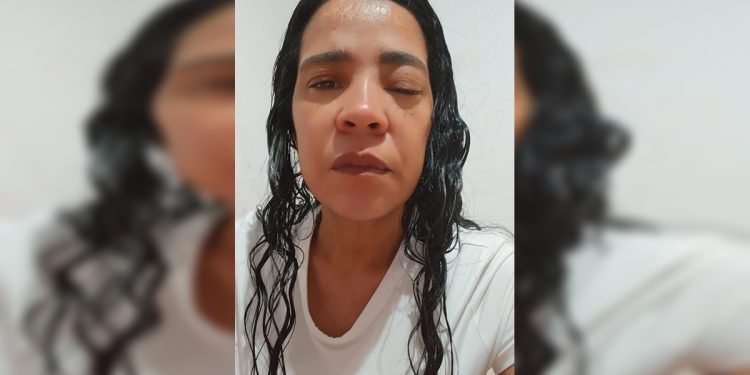 “Sou maltratada pela doença e pelo SUS”, diz mulher com câncer de pele