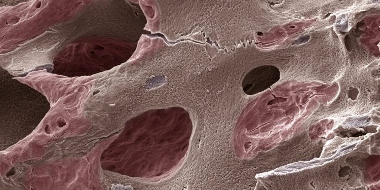 Casos de osteoporose devem disparar até 2050, inclusive no Brasil