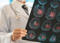 Neurologista explica o que é um AVC e quais são os principais sintomas
