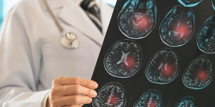 Neurologista explica o que é um AVC e quais são os principais sintomas