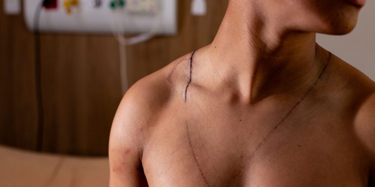 Jovem atingido por raio em ato de Nikolas teve hemorragia no ouvido