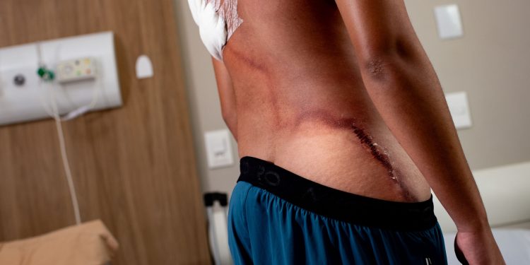 Raio em ato de Nikolas: jovem que teve as costas rasgadas recebe alta