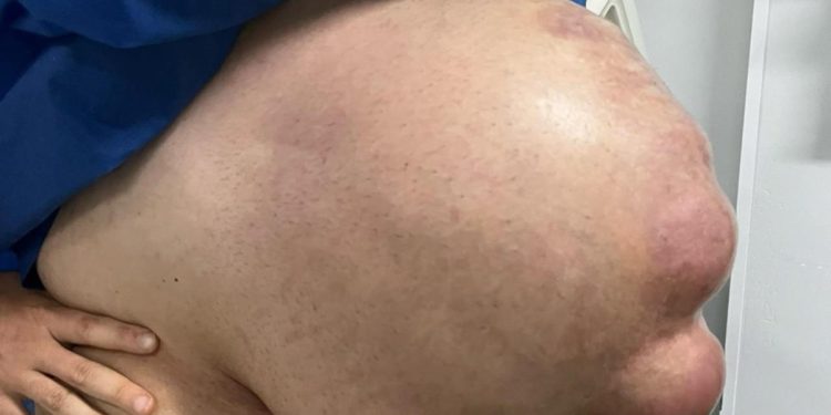 Com hérnia abdominal, homem fica com barriga enorme: “Cresceu em 1 mês”