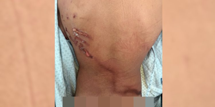 Jovem que teve costas rasgadas por raio em ato de Nikolas: “Achei que tinha 1h de vida”. Veja vídeo