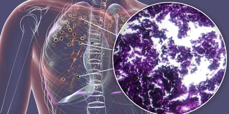 Câncer de pulmão usa “sistema de defesa” para proteger mutação maligna