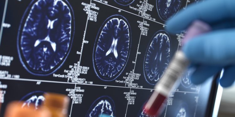 LATE: condição muda entendimento sobre a demência em idosos