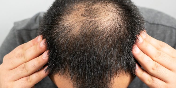 Estudo chinês encontra propriedade em planta para tratar calvície