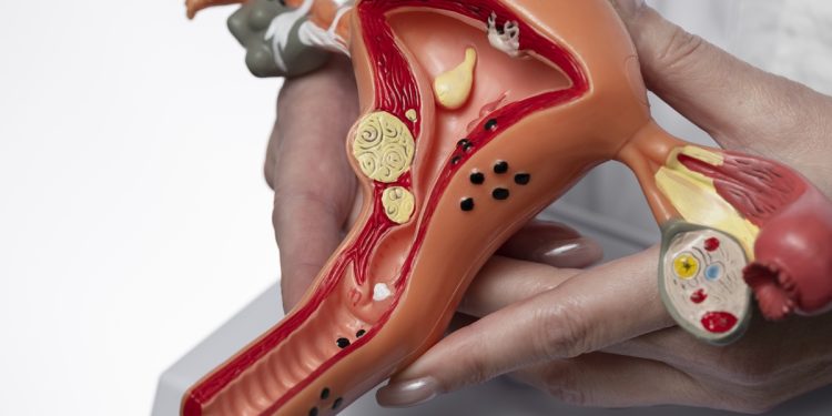Estudo explica por que o câncer de ovário desafia o tratamento