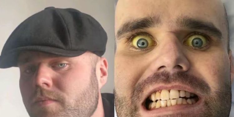 Vício em beber vodca no café da manhã deixa homem com pele amarelada