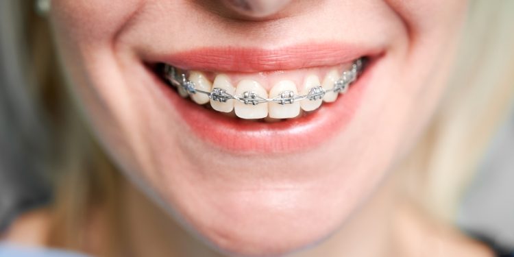 Por que os dentes voltam a entortar após o uso de aparelho ortodôntico
