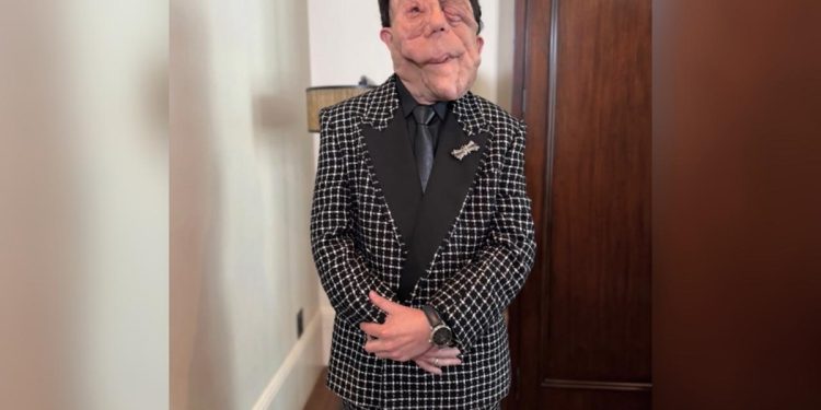 Neurofibromatose: entenda doença rara do ator Adam Pearson