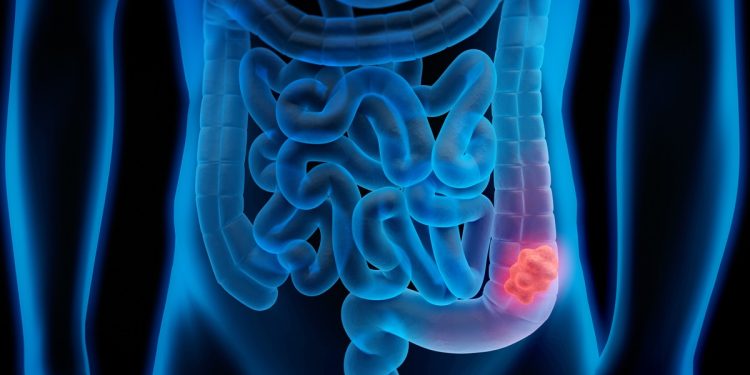 Alerta: saiba qual é o 3º câncer mais comum no DF e como tratá-lo