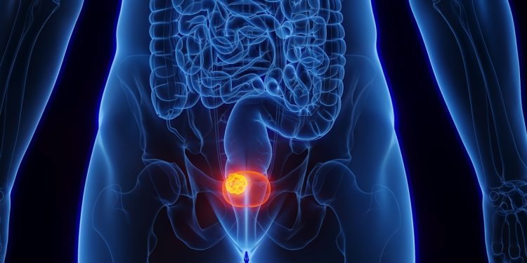 Estudo aponta qual é a relação entre daltonismo e câncer de bexiga