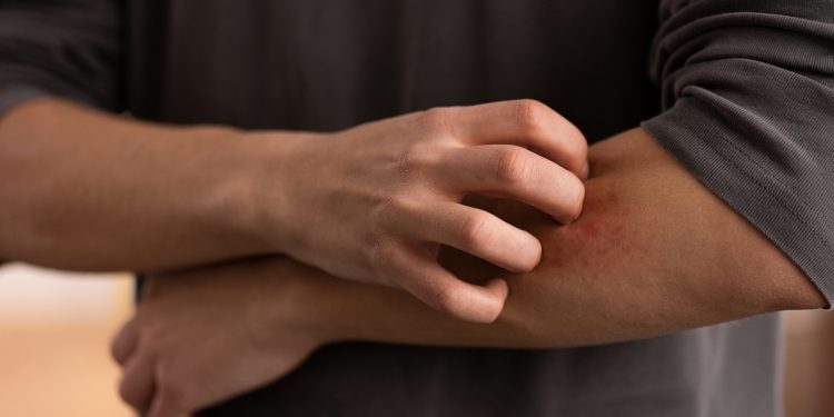 Por que algumas pessoas têm coceira após exercício ou banho quente