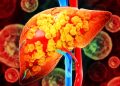Hepatologistas explicam o que causa gordura no fígado