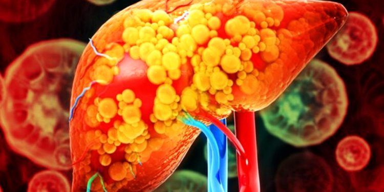 Hepatologistas explicam o que causa gordura no fígado