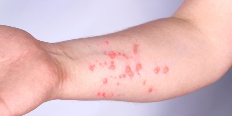 OMS alerta sobre nova variante da mpox e falha do antiviral