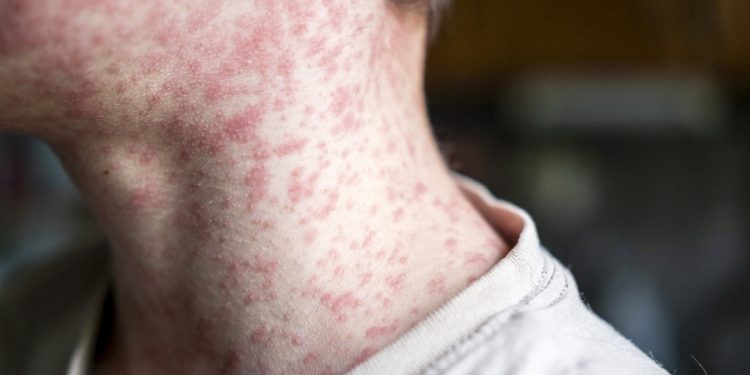 Alta de casos de sarampo nas Américas coloca Brasil em alerta