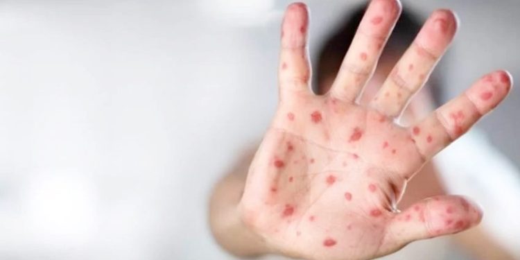 Alta de sarampo nas Américas leva DF a reforçar imunização