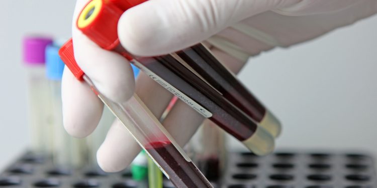 Exame de sangue pode detectar cicatrizes no fígado antes do câncer