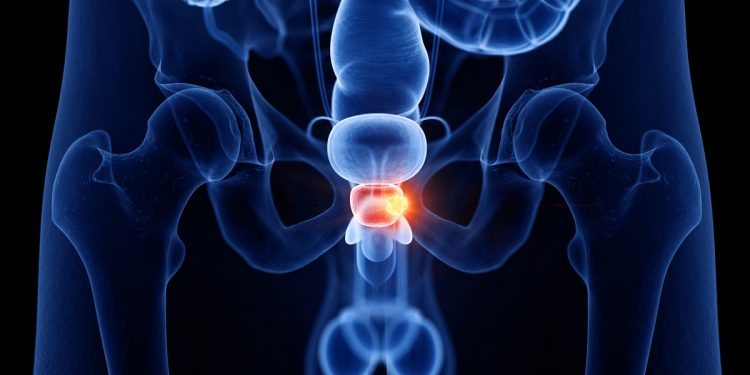 Urologista lista quais são os primeiros sintomas de próstata aumentada