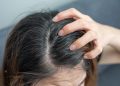 Tomar sol no cabelo ajuda a diminuir a caspa? Entenda se efeito existe