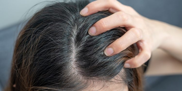Tomar sol no cabelo ajuda a diminuir a caspa? Entenda se efeito existe