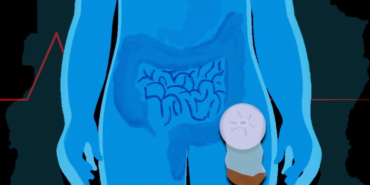 Por que pacientes que usam bolsas de colostomia temem infecção no DF