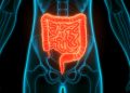 Como funciona o novo exame do SUS para detectar câncer de intestino
